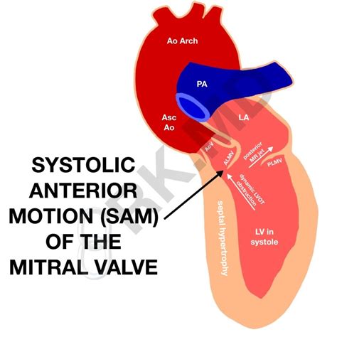 lv obstruction flow|ventricular outflow tract obstruction causes.